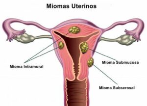 Miomas y fertilidad